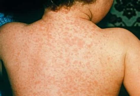 rash in bacterial meningitis